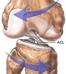 ACL Tear - Image from medlineplus.gov - Image for Educational and Informative purposes only