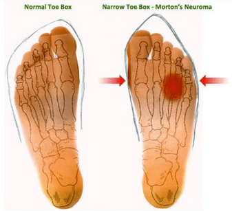 Morton's Neuroma - Image from www.mortonsneuroma.com - Image for Educational & Informative purposes only 