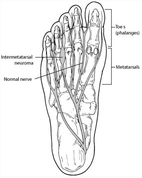 Morton's Neuroma Diagram - Image from www.foothealthfacts.org - Image for Educational & Informative purposes only 