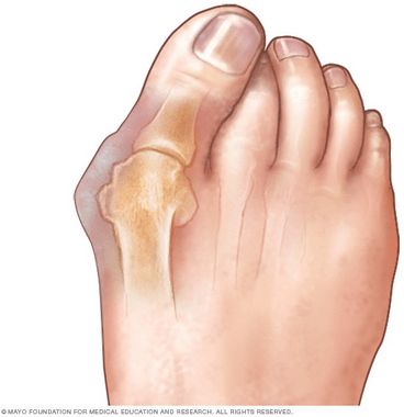 Hallux Valgus (Bunions) - Image from Mayo Clinic - Image for Educational & Informative purposes only 