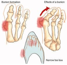 Hallux Valgus Bunions - Image from www.podiatristsurgery.com - Image for Educational & Informative purposes only 