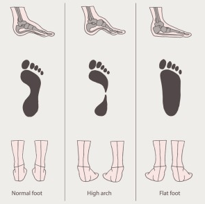 Flat Feet, High Arches and Normal Feet Imprints - Image from Providence Orthopaedics