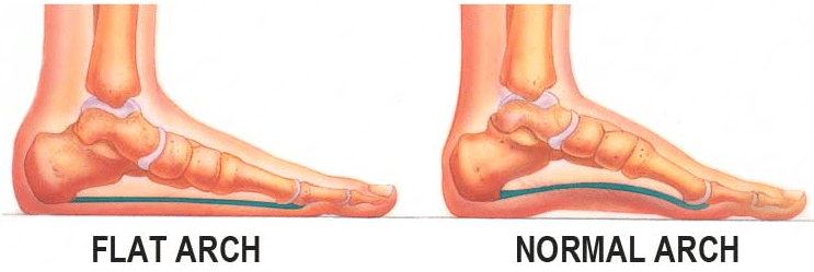 Flat Feet - Image from University Foot and Ankle Institute