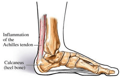Achilles Tendonitis - Image from paindoctor.com - Image for Educational and Informative purposes only
