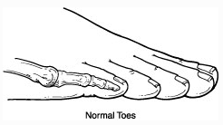 Normal Toes - Image from Foot Health Facts - Consumer Website for the American College of Foot and Ankle Surgeons - Image for Educational & Informative purposes only 