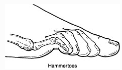 Hammertoes - Image from Foot Health Facts - Consumer Website for the American College of Foot and Ankle Surgeons